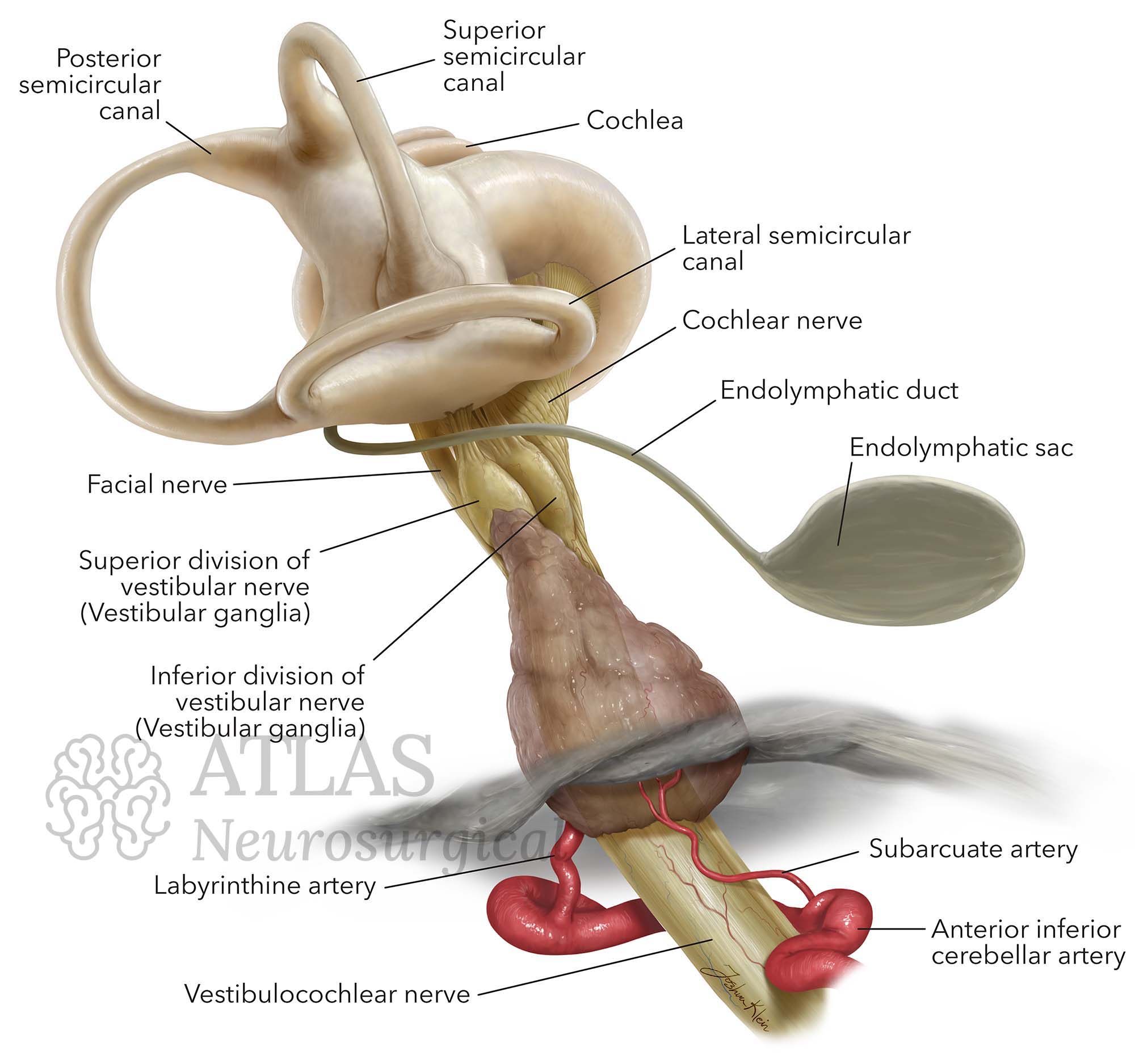 Neurosurgical Illustration of Inner ear anatomy, nerves and tumor