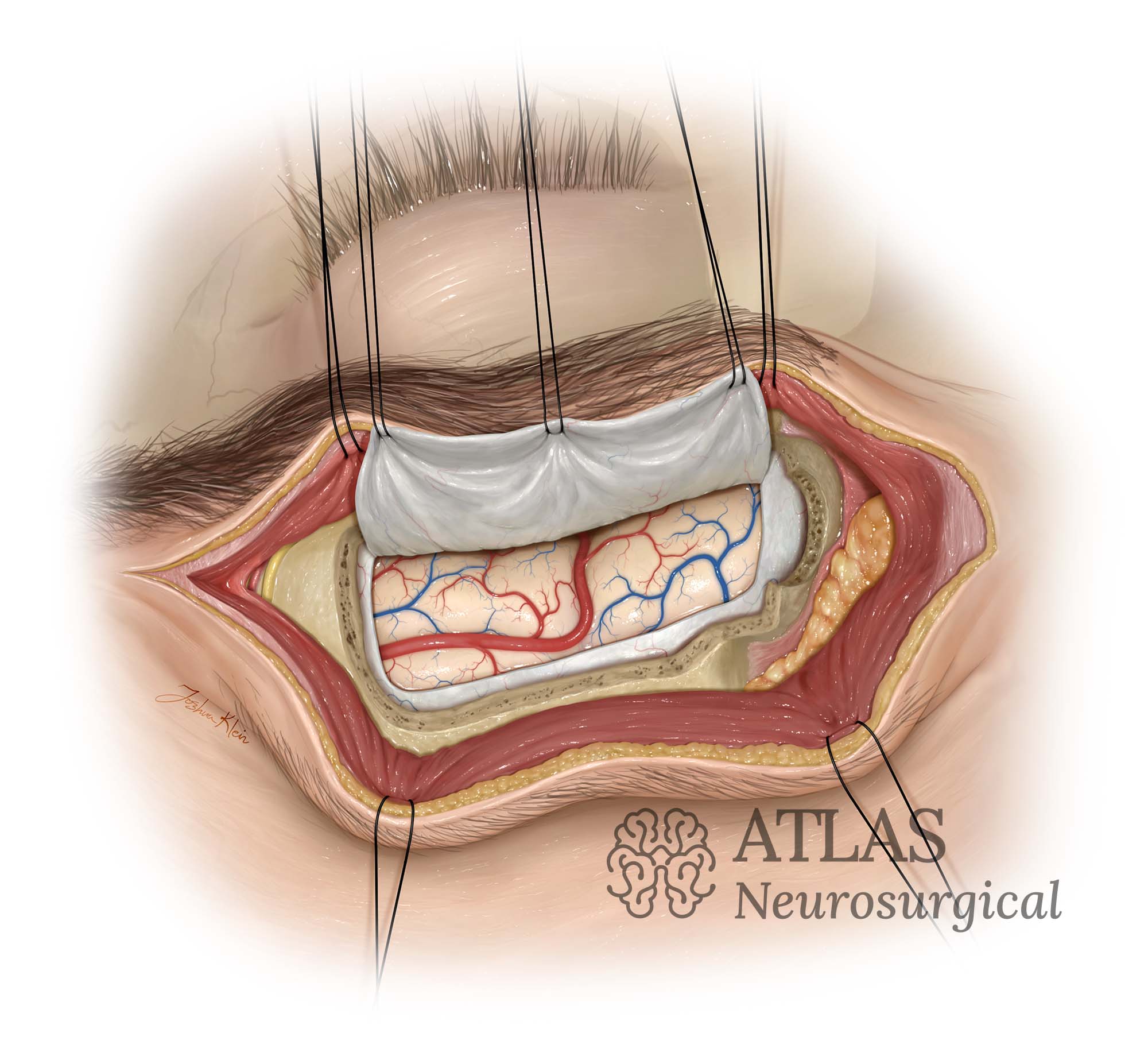 Neurosurgical illustration of Supraorbital Approach