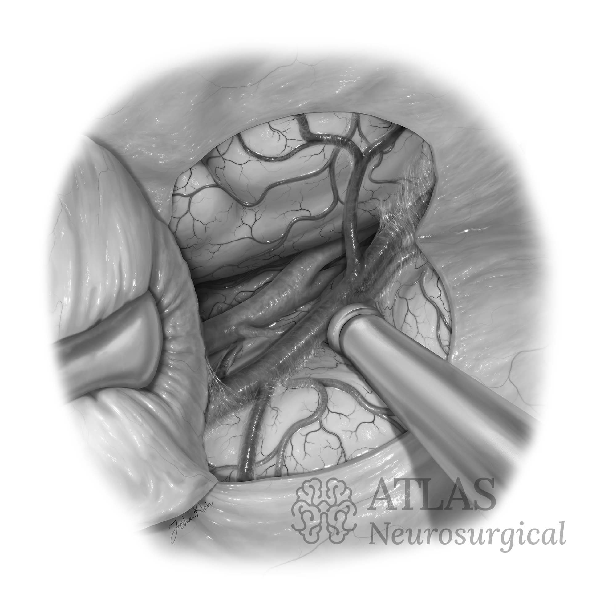 Neurosurgical Illustration of Transorbital approach